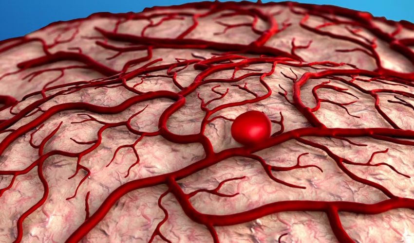 临沂脑出血后遗症