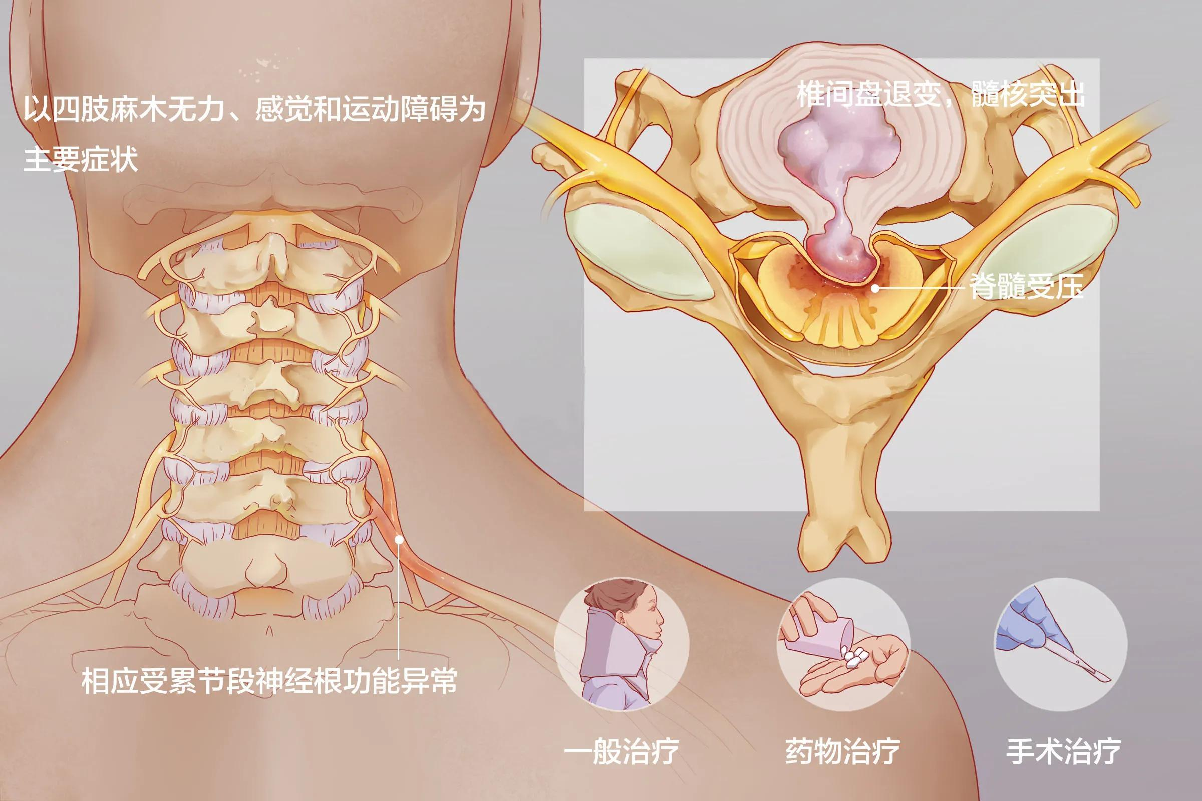 怎么判断颈椎病