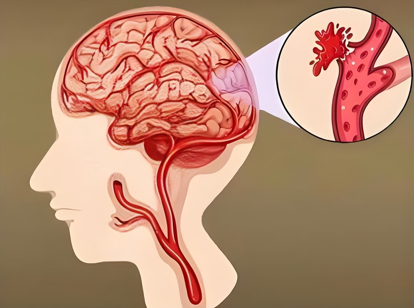 脑供血不足有什么表现？